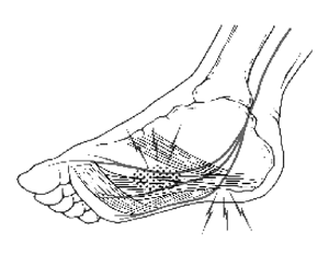 足底筋膜炎　【 plantar fascitis 】